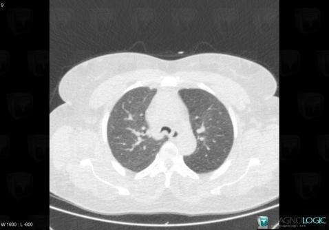 Tracheomalacia, Airways, CT