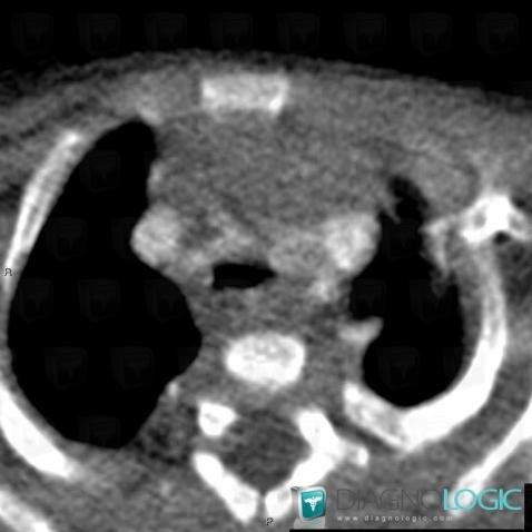 Tracheomalacia, Airways, CT