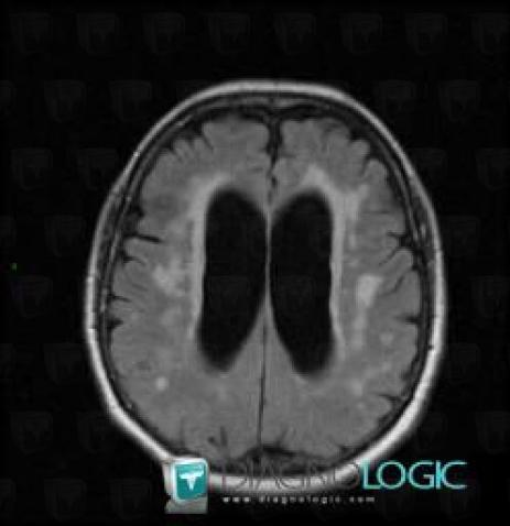 Transependymal CSF flow, Ventricles / Periventricular region, MRI