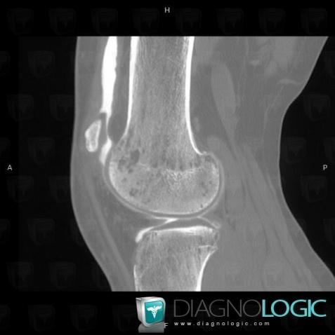 Transient regional osteoporosis, Femorotibial joints - Intercondylar notch, CT