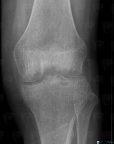 Radiology case : Transient regional osteoporosis (X rays) - Diagnologic