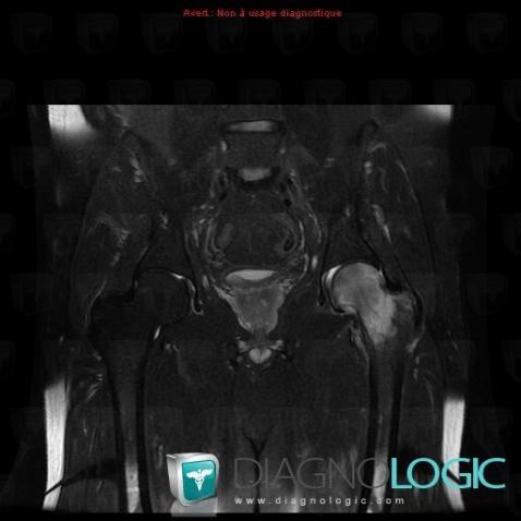 Transient regional osteoporosis, Femur - Proximal part, MRI