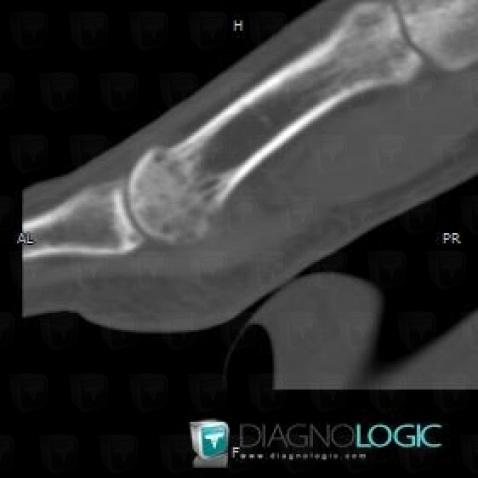 Transient regional osteoporosis, Metatarsal bones, CT