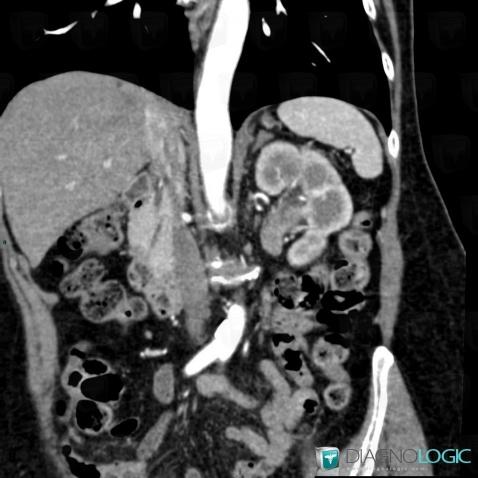 Transitional cell carcinoma, Collecting system, CT