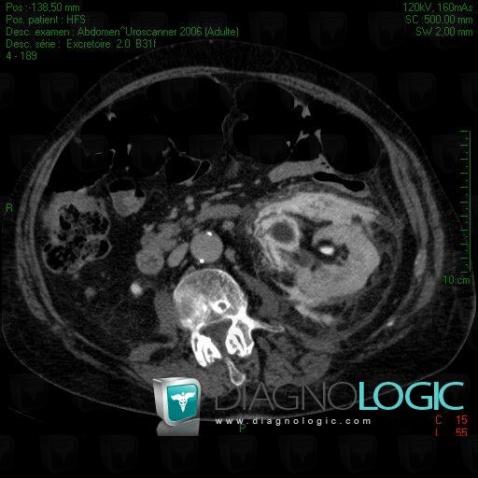 Transitional cell carcinoma, Collecting system, CT