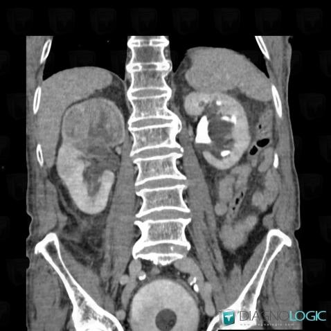 Transitional cell carcinoma, Kidney, Collecting system, CT