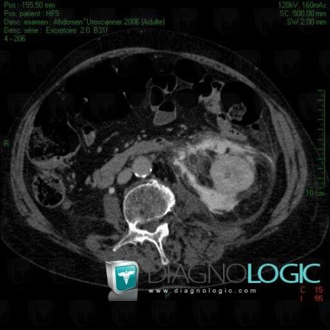 Transitional cell carcinoma, Ureter, CT