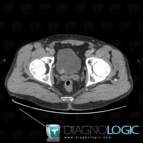 Transitional cell carcinoma, Ureter, CT