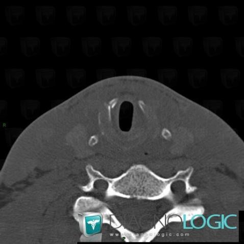 Traumatisme laryngé, Larynx, Scanner