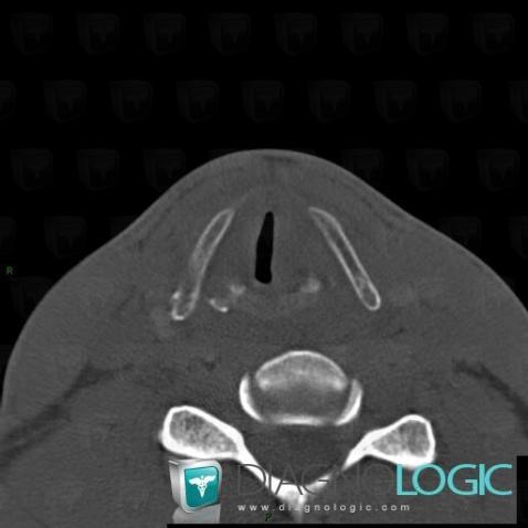 Traumatisme laryngé, Larynx, Scanner