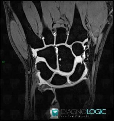 Triangular fibrocartilage complex lesion, Other soft tissues/nerves - Wrist, MRI