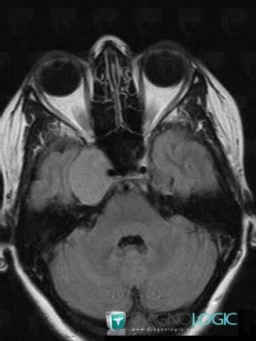 Trigeminal schwannoma, Pituitary gland and parasellar region, MRI