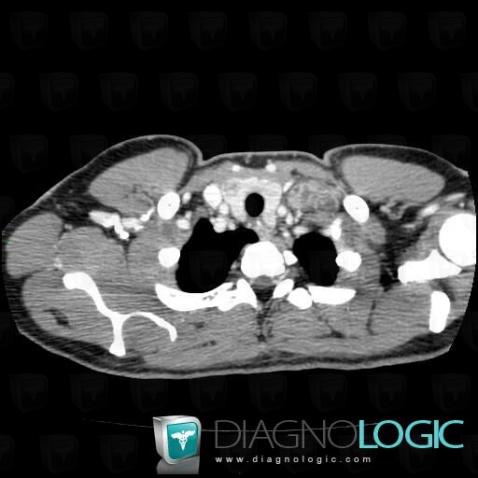 Tuberculose , Espaces profonds-cou, Scanner