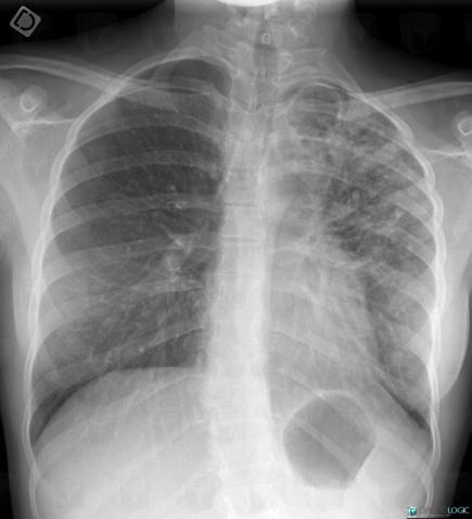 Tuberculose , Parenchyme pulmonaire, Hile pulmonaire, Radio