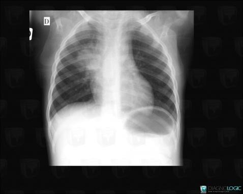 cas-radiologie-tuberculose-scanner-radio-diagnologic