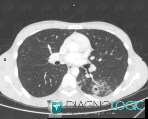 Tuberculose , Parenchyme pulmonaire, Scanner