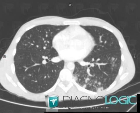 Tuberculose , Parenchyme pulmonaire, Scanner
