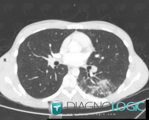 Tuberculose , Parenchyme pulmonaire, Scanner