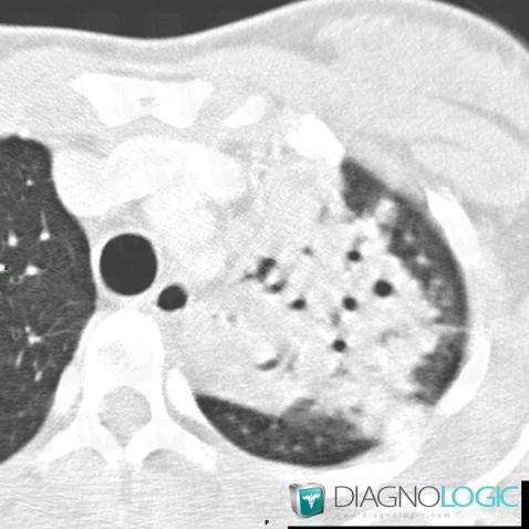 Tuberculose , Parenchyme pulmonaire, Scanner