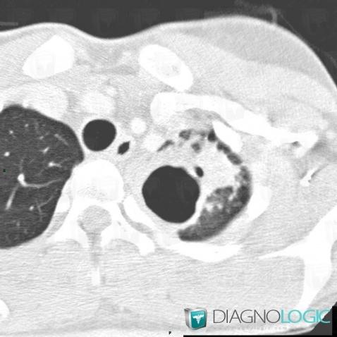 Tuberculose , Parenchyme pulmonaire, Scanner