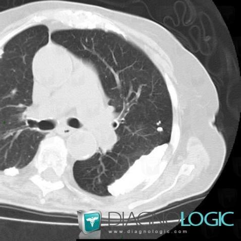 Tuberculose , Plèvre, Scanner