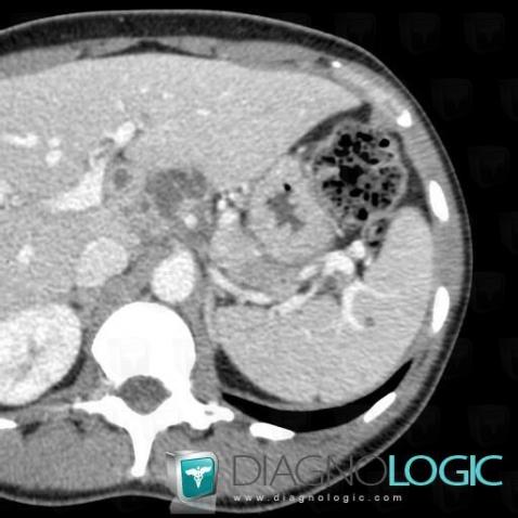 Tuberculose , Rate, Scanner