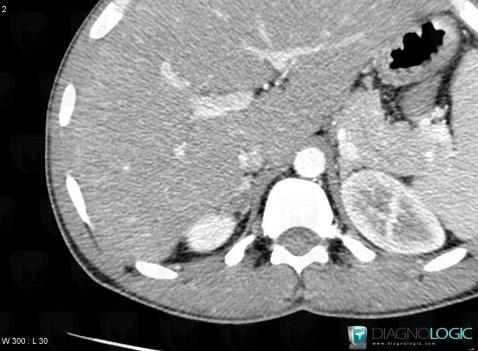 Tuberculosis, Adrenal glands, CT