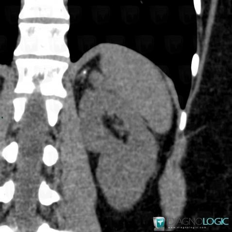 Tuberculosis, Adrenal glands, CT