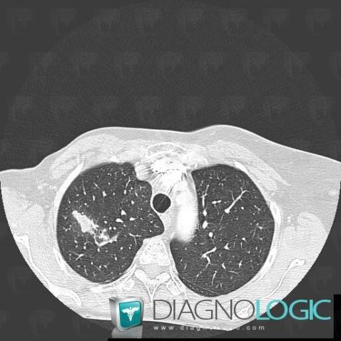 Tuberculosis, Airways, CT