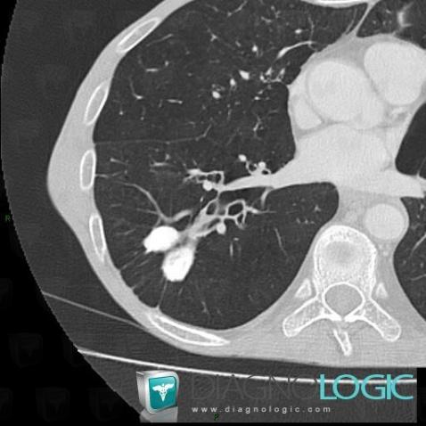 Tuberculosis, Airways, CT