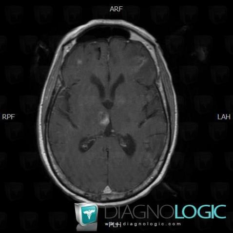 Tuberculosis, Basal ganglia and capsule, Brainstem, Theoretical