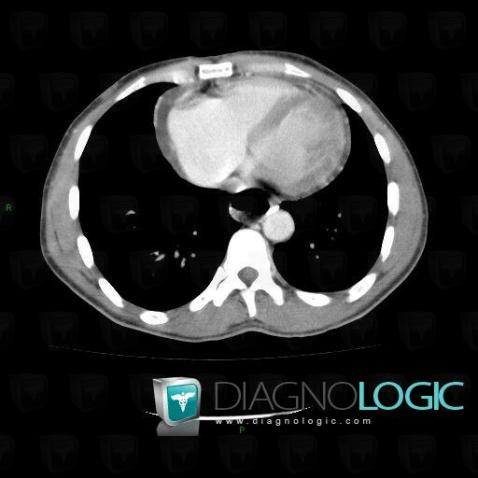 Tuberculosis, Cardiac cavities / Pericardium, CT