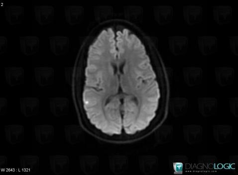 Tuberculosis, Cerebral hemispheres, MRI