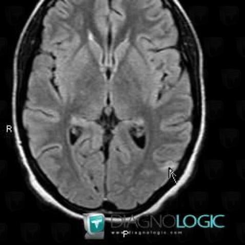 Tuberculosis, Cerebral hemispheres, MRI