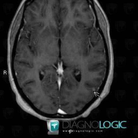 Tuberculosis, Cerebral hemispheres, MRI