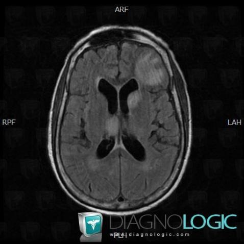 Tuberculosis, Cerebral hemispheres, Theoretical