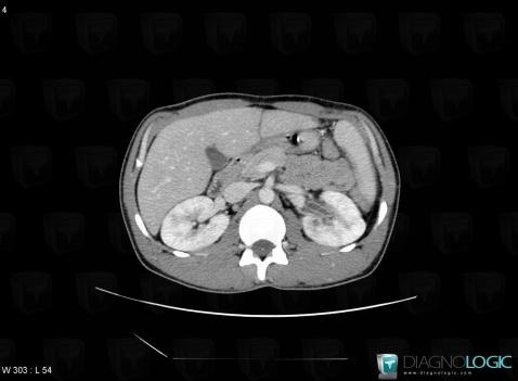 Tuberculosis, Collecting system, CT