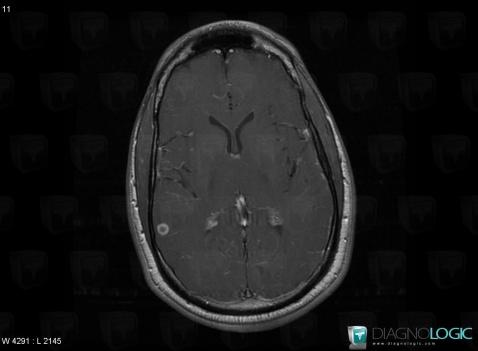 Tuberculosis, Cortico subcortical region, Cerebral hemispheres, MRI