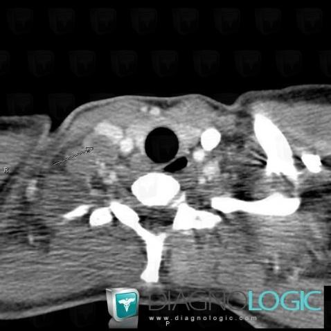 Tuberculosis, Deep neck spaces, CT