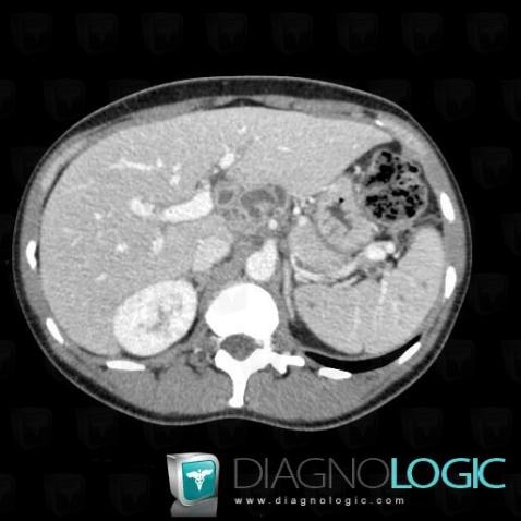 Tuberculosis, Liver, Mesentery / Peritoneum, CT