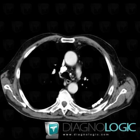 Tuberculosis, Mediastinum, CT