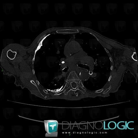 Tuberculosis, Mediastinum, CT