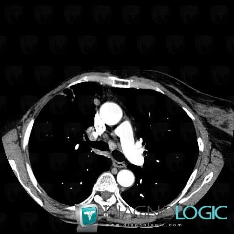 Tuberculosis, Mediastinum, CT