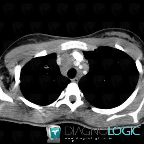 Tuberculosis, Mediastinum, CT