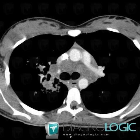 Tuberculosis, Mediastinum, CT