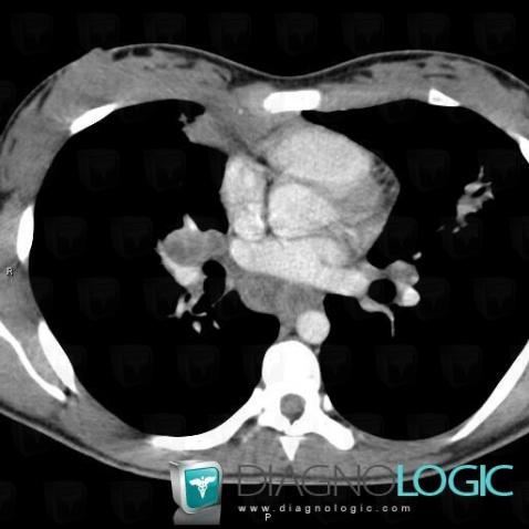 Tuberculosis, Mediastinum, CT