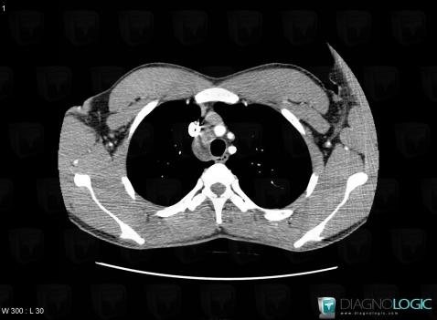 Tuberculosis, Mediastinum, CT