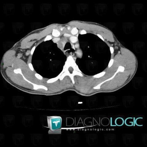 Tuberculosis, Mediastinum, CT