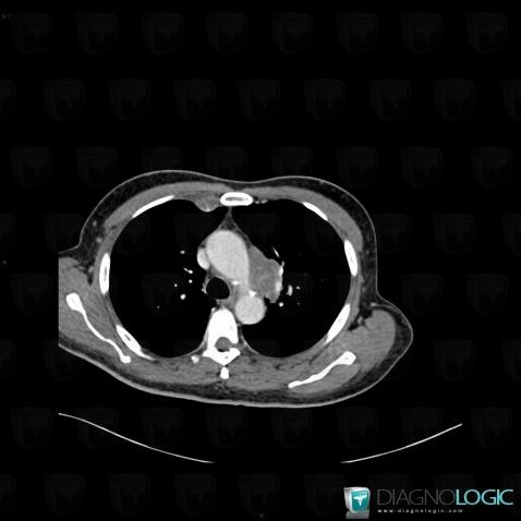 Tuberculosis, Mediastinum, CT