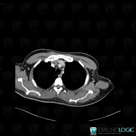 Tuberculosis, Mediastinum, CT